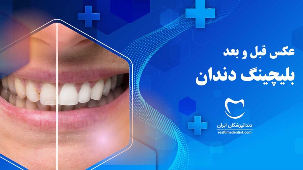 عکس قبل و بعد بلیچینگ دندان