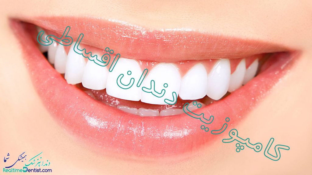 کامپوزیت دندان اقساطی در شیراز