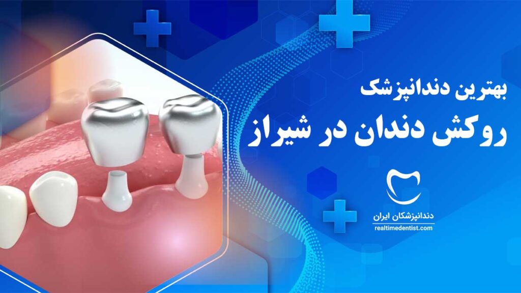 روکش دندان در شیراز