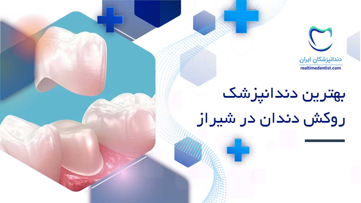 روکش دندان در شیراز