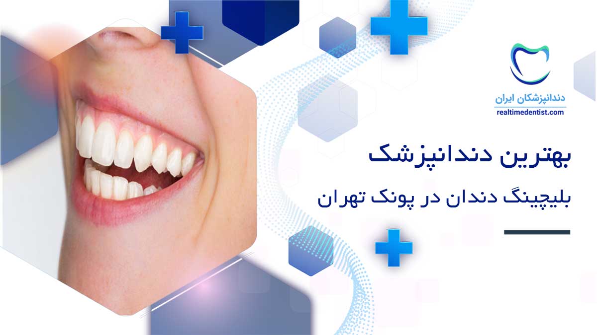 بلیچینگ دندان در پونک تهران