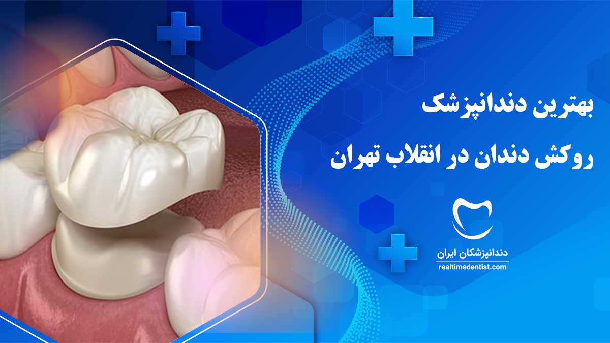 روکش دندان در انقلاب تهران