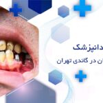 ایمپلنت دندان در گاندی تهران