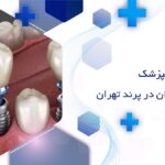دندانپزشک ایمپلنت دندان در پرند تهران