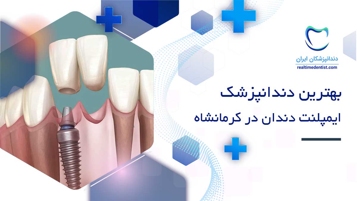بهترین متخصص ایمپلنت در کرمانشاه
