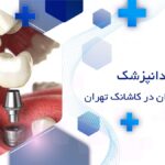 دندانپزشک ایمپلنت دندان در کاشانک تهران