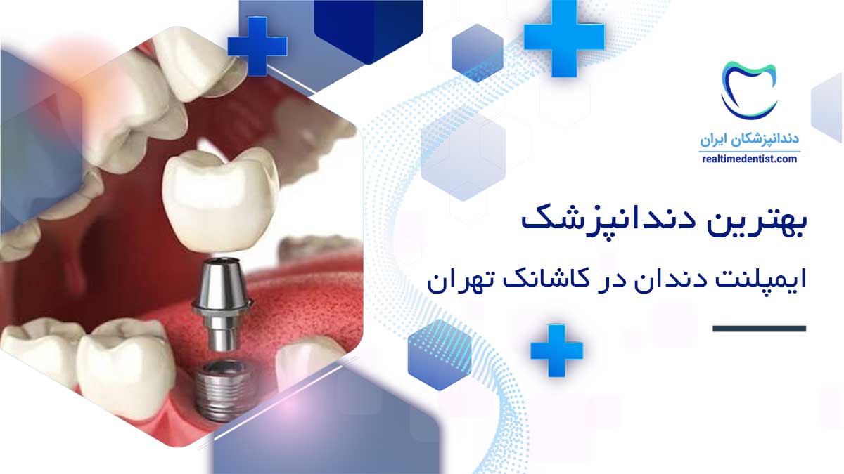 دندانپزشک ایمپلنت دندان در کاشانک تهران