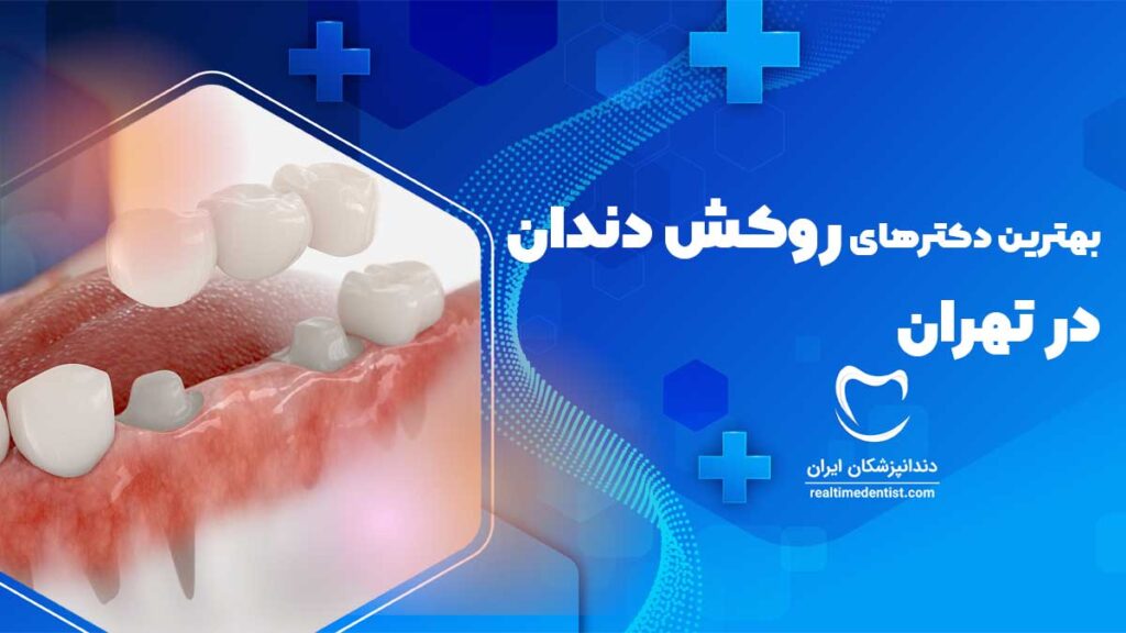 دکترهای روکش دندان در تهران