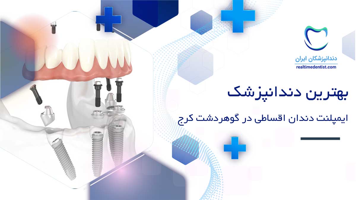 ایمپلنت دندان اقساطی در گوهردشت کرج