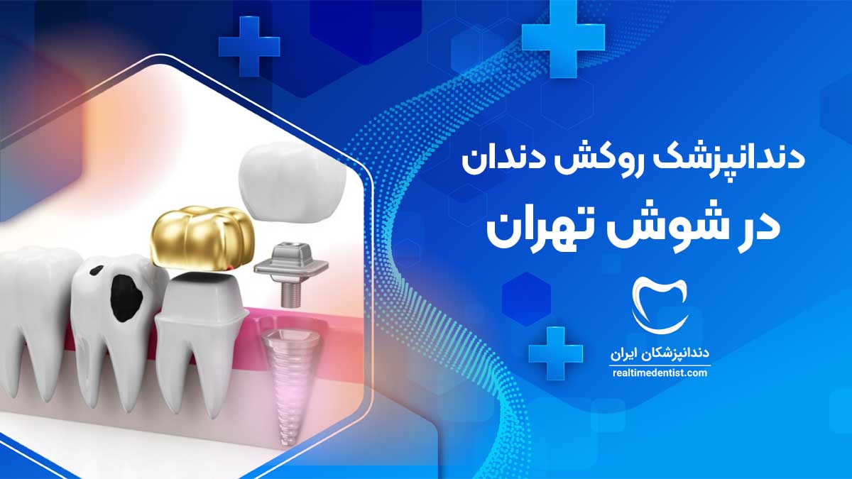 روکش دندان در شوش تهران