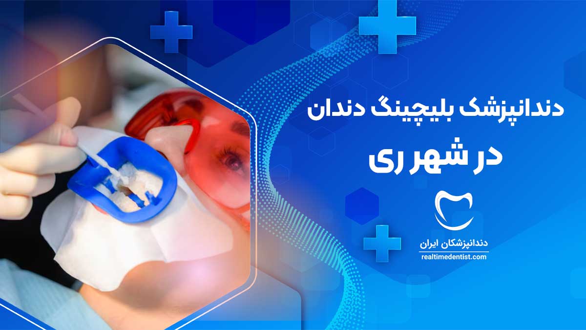 بلیچینگ دندان در شهر ری