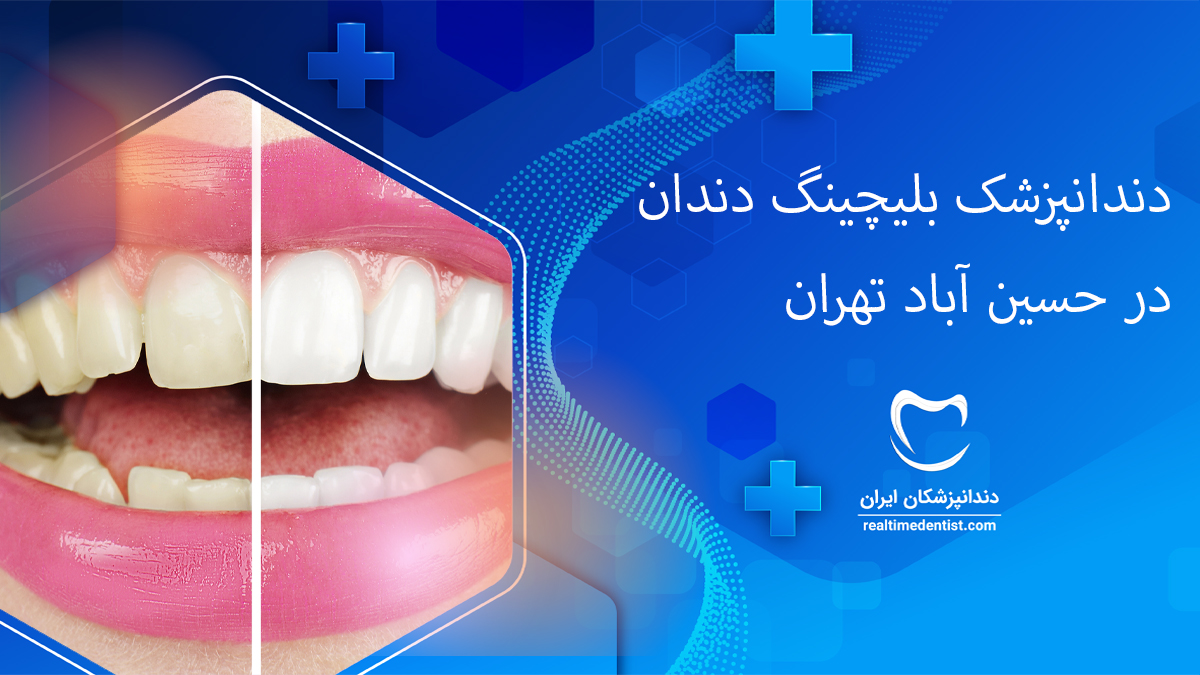 بلیچینگ دندان در حسین آباد تهران