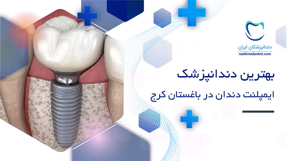 ایمپلنت دندان در باغستان کرج