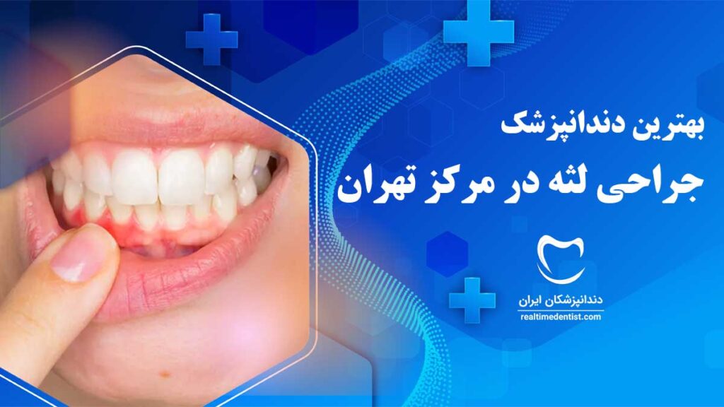 بهترین متخصص جراحی لثه در مرکز تهران