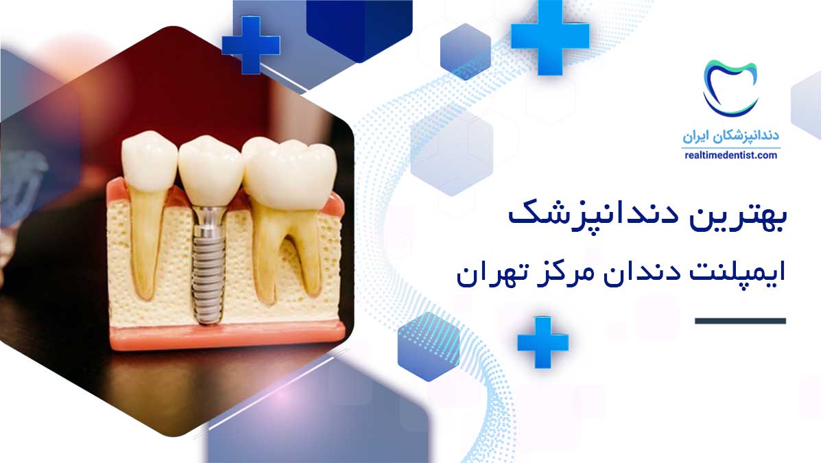 بهترین متخصص ایمپلنت در مرکز تهران