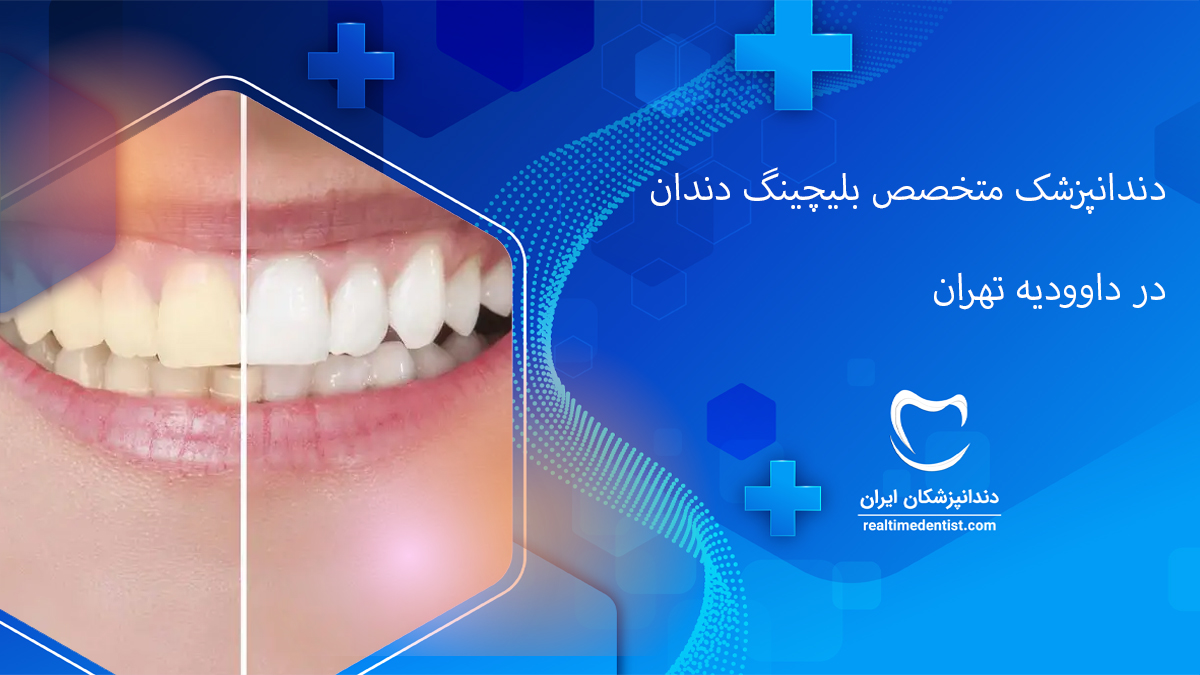 بلیچینگ دندان در داوودیه تهران
