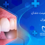 لمینت دندان در داوودیه تهران