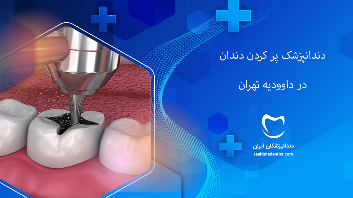پر کردن دندان در داوودیه تهران