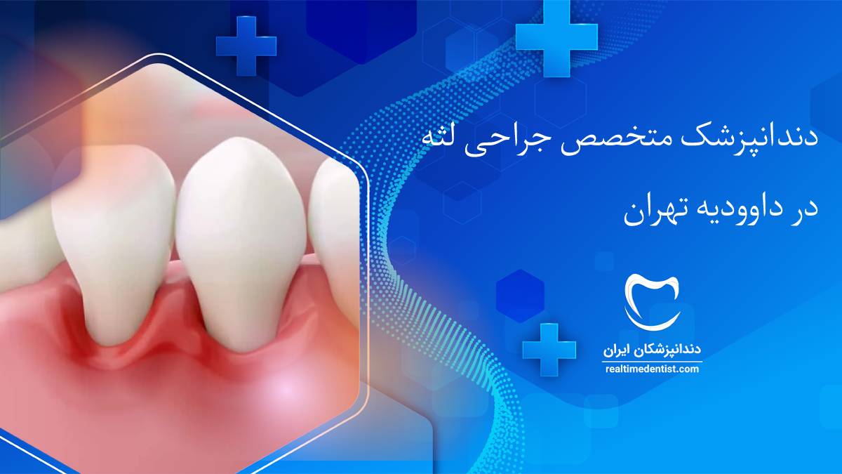 جراحی لثه در داوودیه تهران