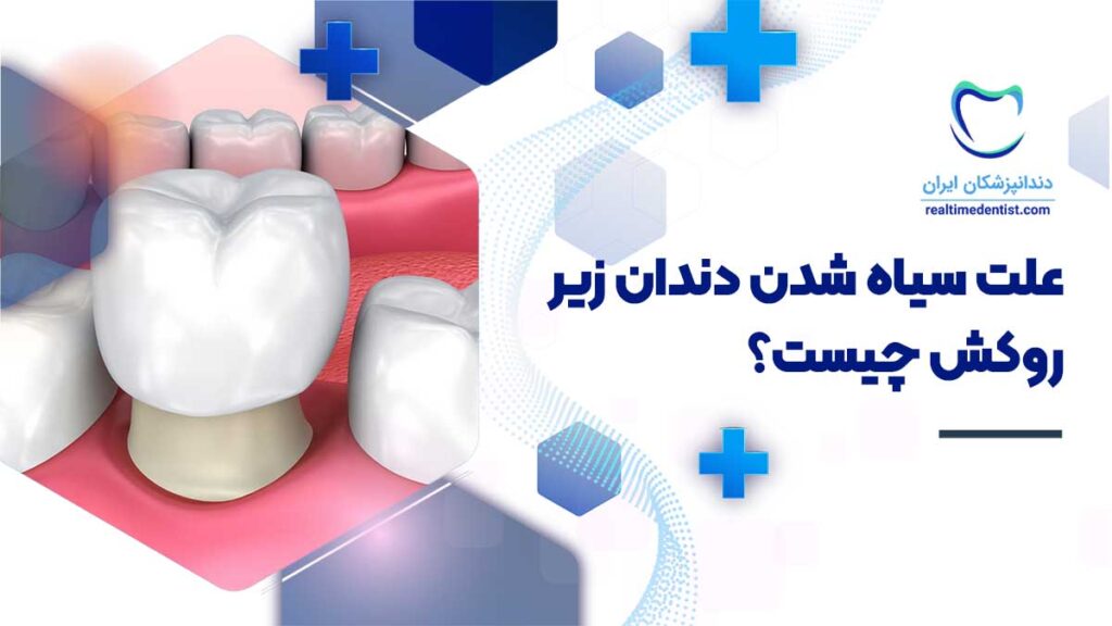 علت سیاه شدن دندان زیر روکش چیست؟