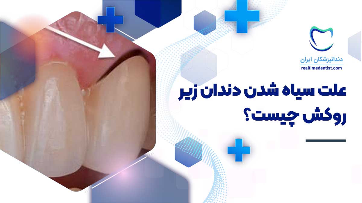 علت سیاه شدن دندان زیر روکش چیست؟