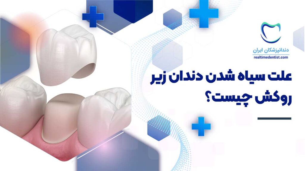 علت سیاه شدن دندان زیر روکش چیست؟