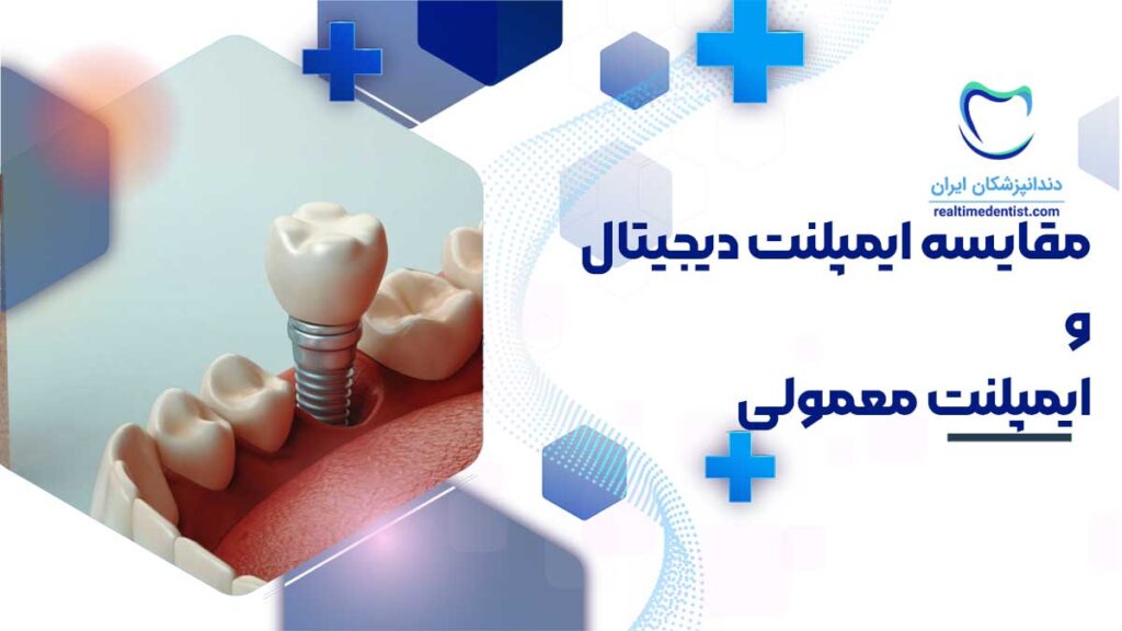 مقایسه ایمپلنت دیجیتال و ایمپلنت معمولی
