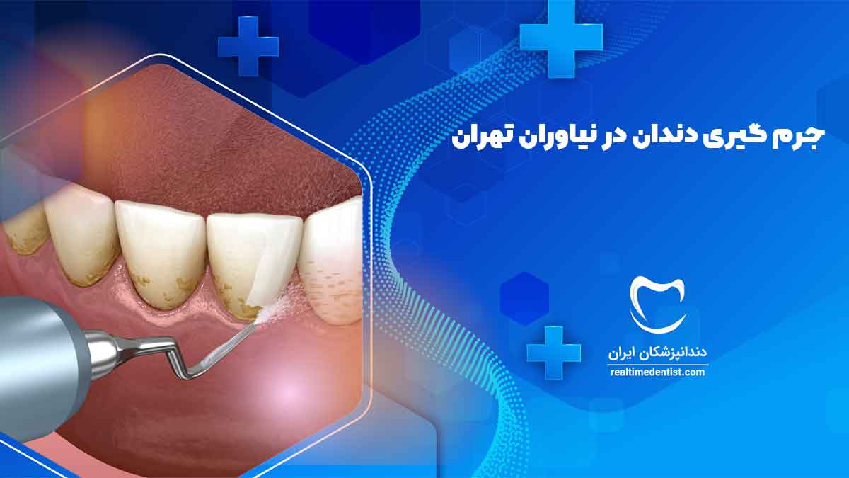 جرم گیری دندان در نیاوران تهران - دندانپزشکان ایران