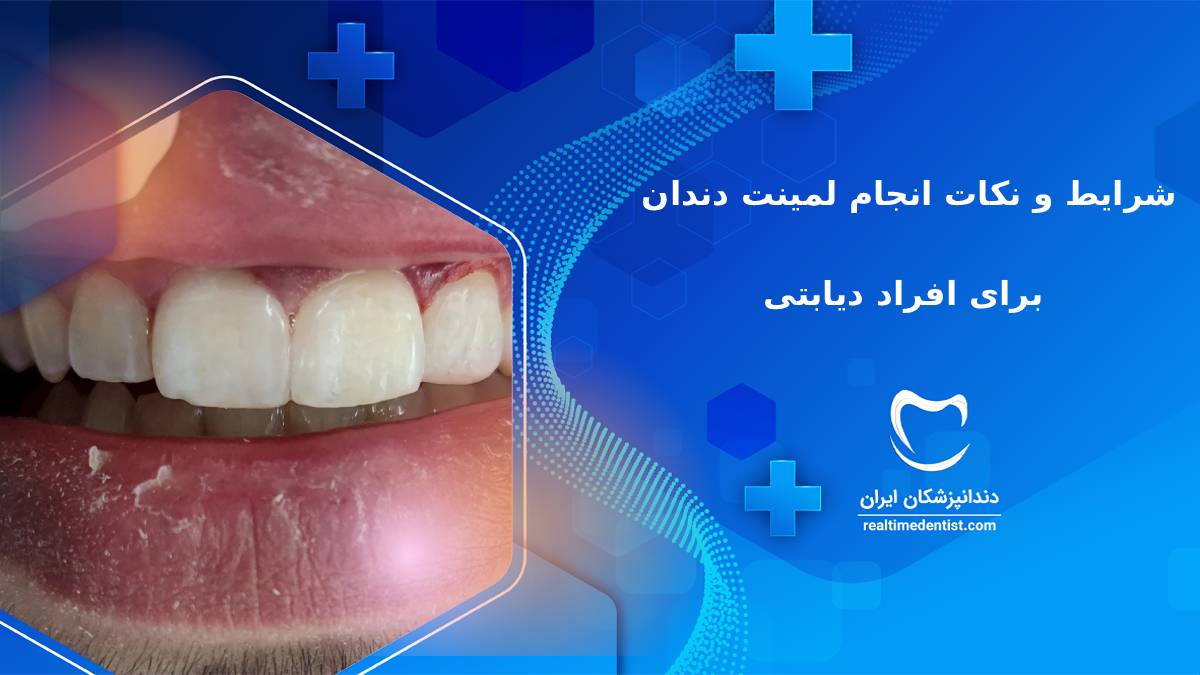 شرایط و نکات انجام لمینت دندان برای دیابتی ها
