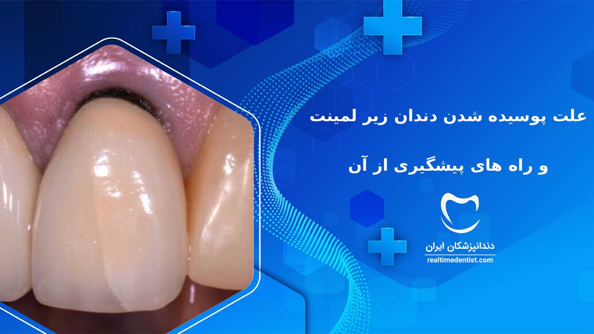 علت پوسیده شدن دندان زیر لمینت و راه های پیشگیری از آن