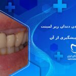 علت پوسیده شدن دندان زیر لمینت و راه های پیشگیری از آن