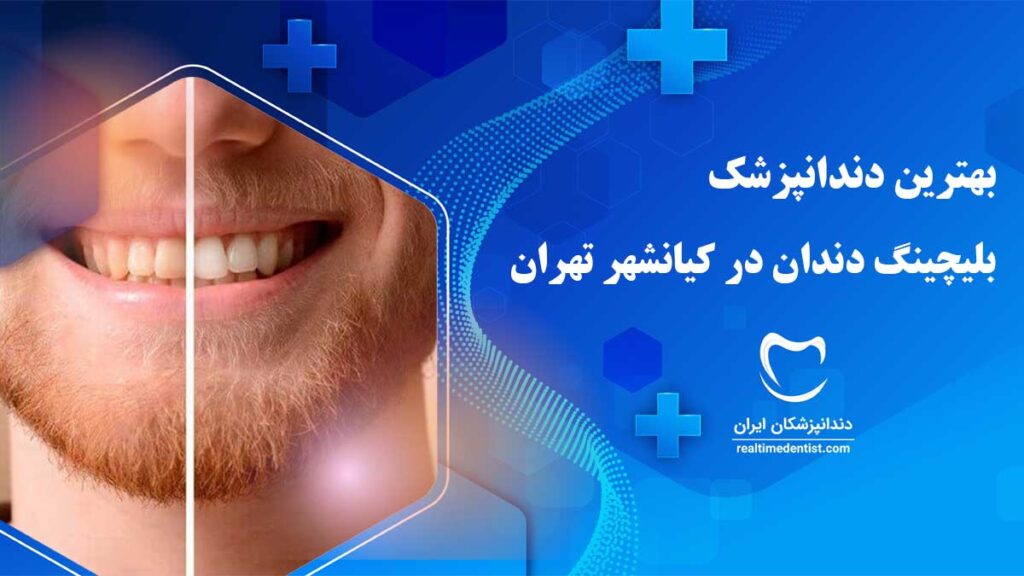 بلیچینگ دندان در کیانشهر تهران