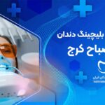 بلیچینگ دندان در مصباح کرج