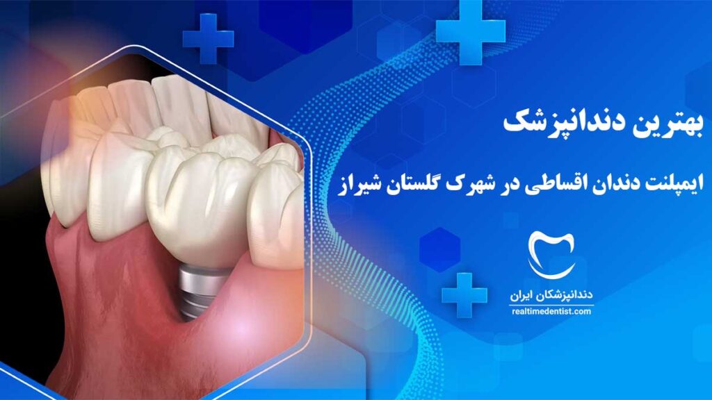 ایمپلنت اقساطی در شهرک گلستان شیراز