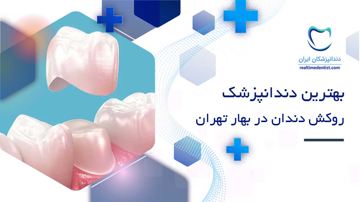 روکش دندان در بهار تهران