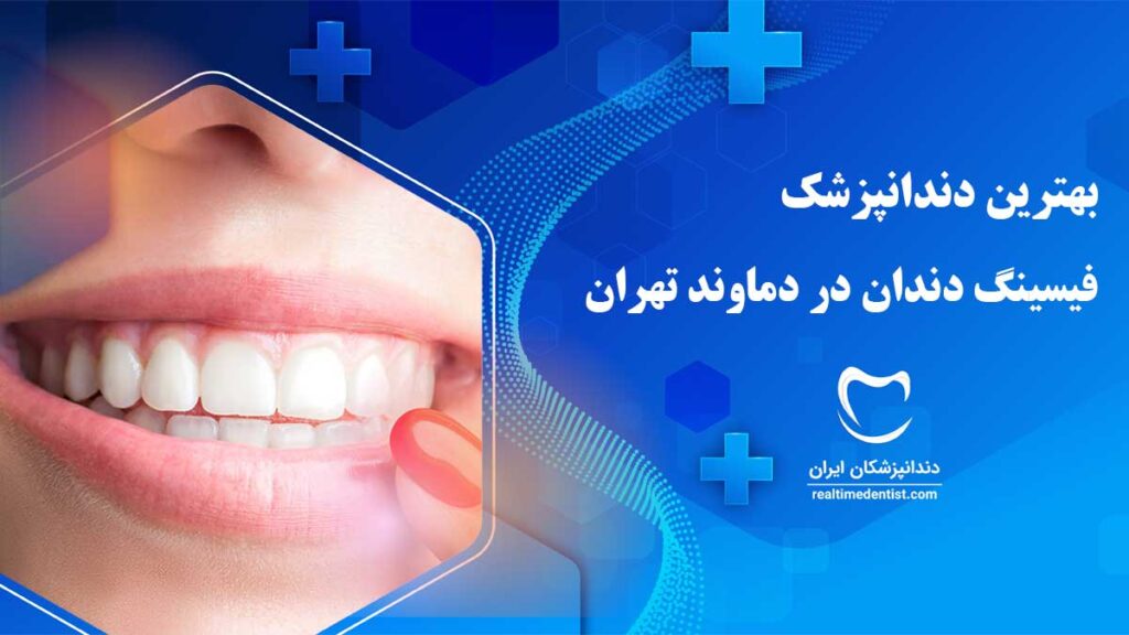 فیسینگ دندان در دماوند تهران