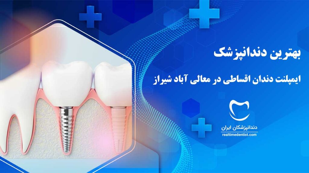 ایمپلنت اقساطی در معالی آباد شیراز