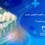 آیا روکش دندان عصب کشی شده الزامی است؟