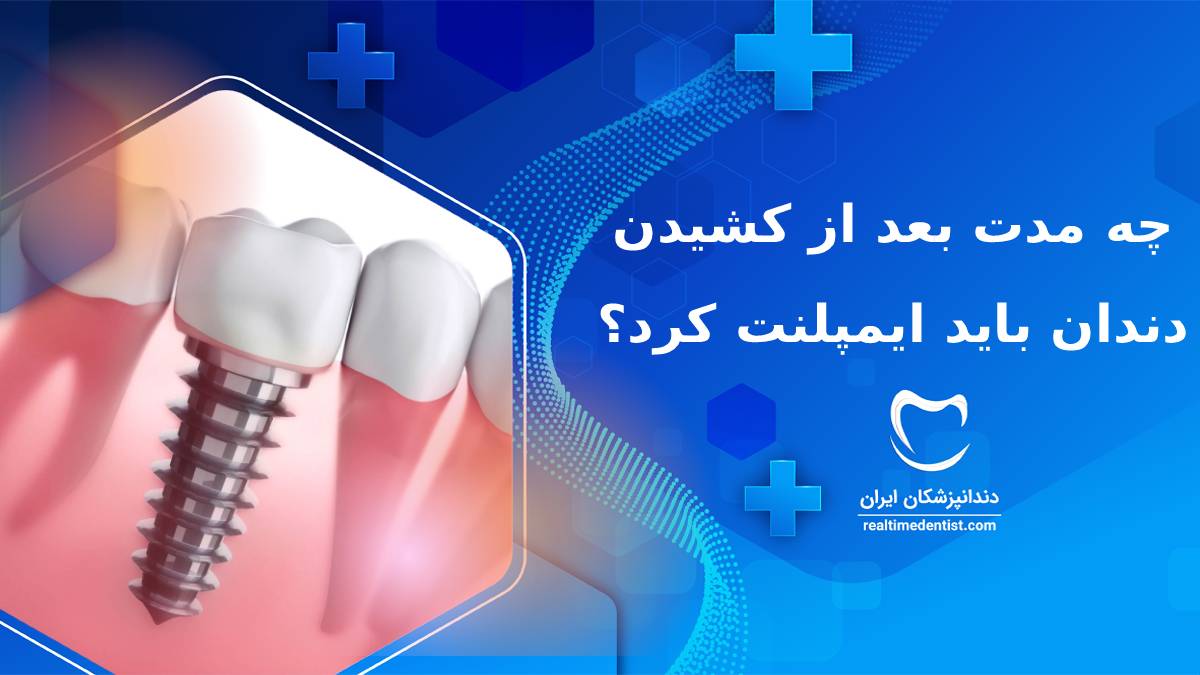 چه مدت بعد از کشیدن دندان باید ایمپلنت کرد؟