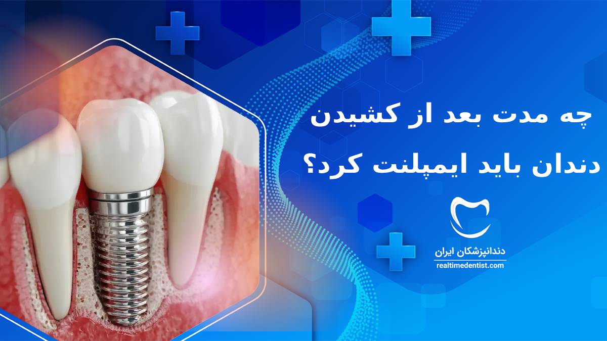 چه مدت بعد از کشیدن دندان باید ایمپلنت کرد؟