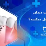ایمپلنت دندان چقدر طول میکشد؟