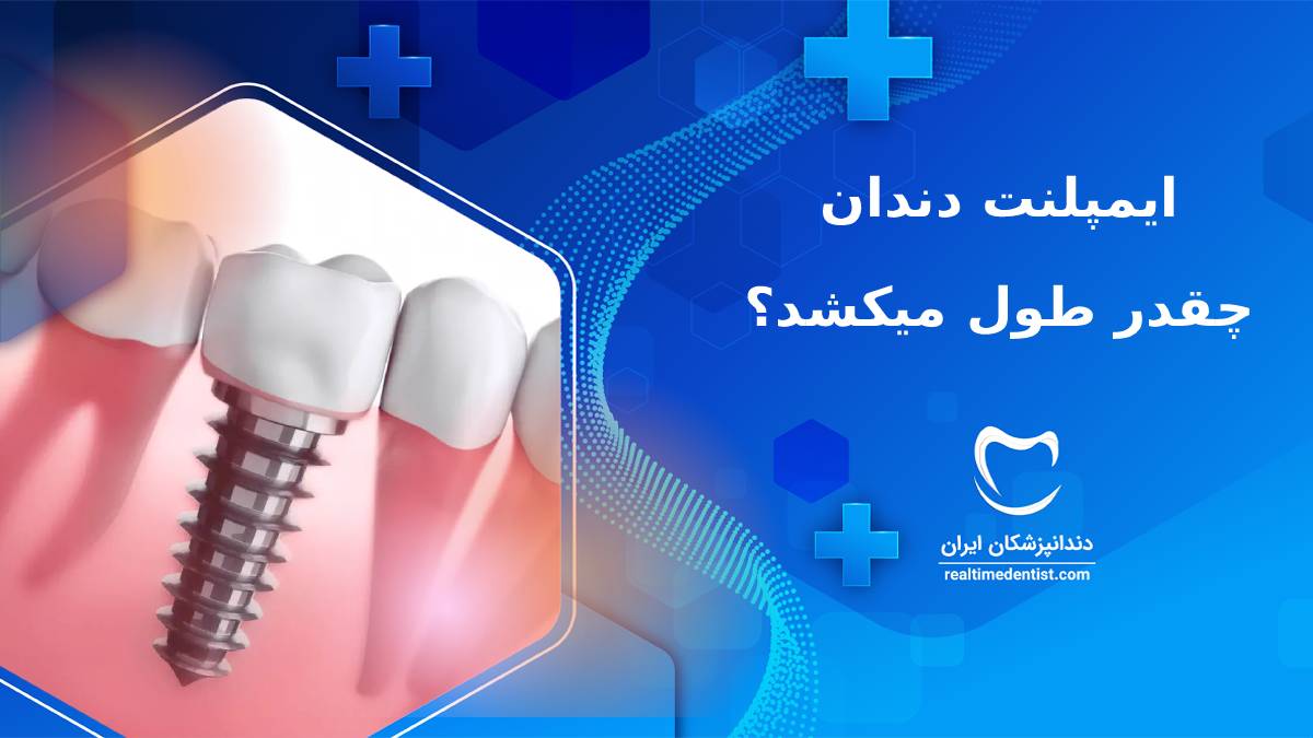 ایمپلنت دندان چقدر طول میکشد؟