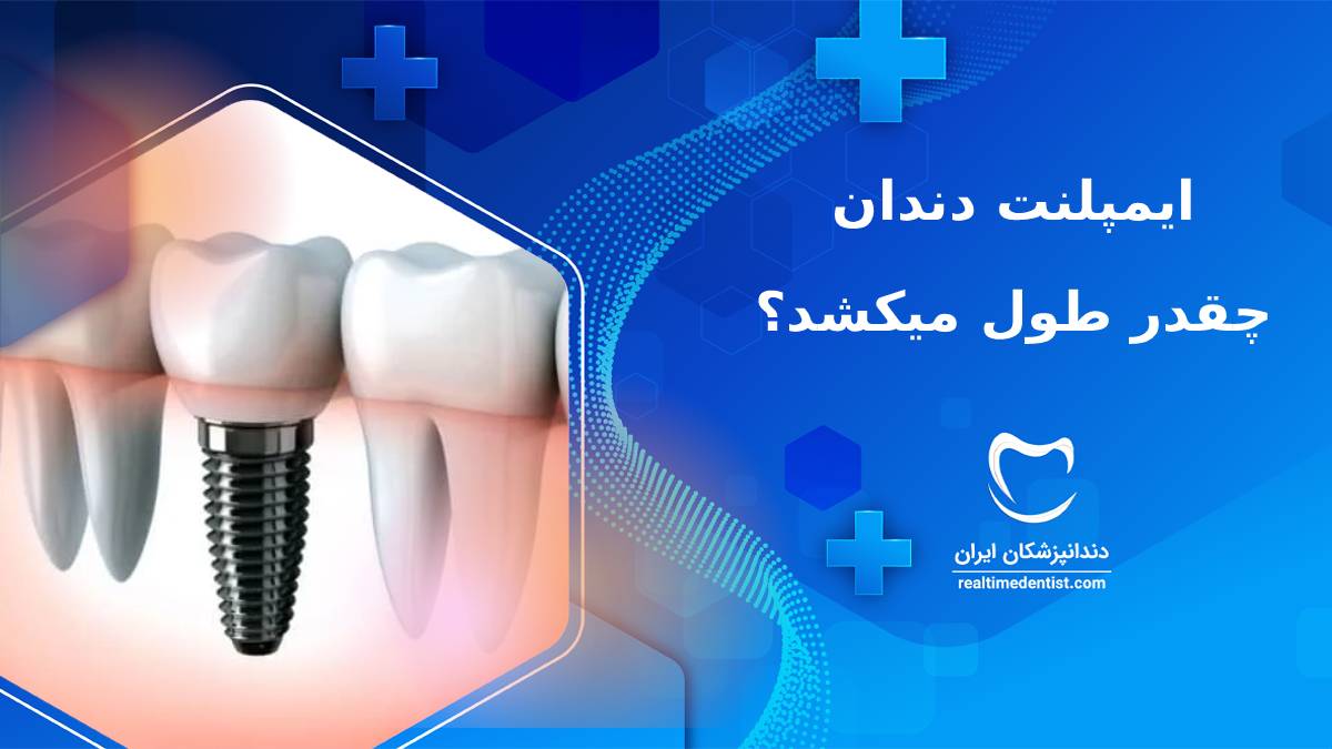 ایمپلنت دندان چقدر طول میکشد؟