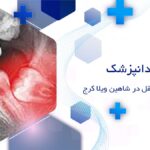 جراحی دندان عقل در شاهین ویلا کرج