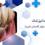 جراحی لثه در بلوار گلستان شیراز