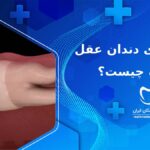 نشانه های دندان عقل نهفته چیست؟