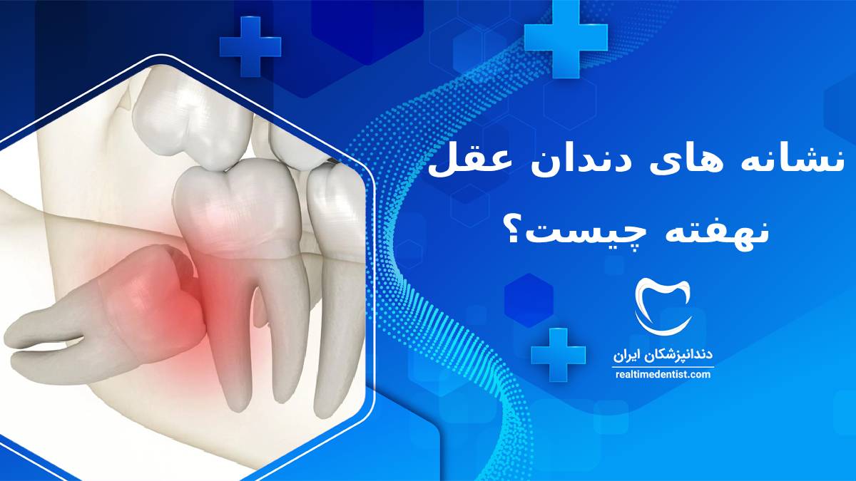 نشانه های دندان عقل نهفته چیست؟ 