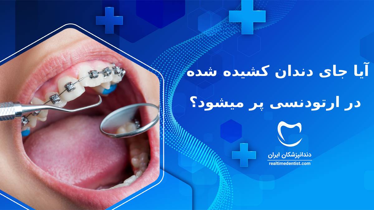 آیا جای دندان کشیده شده در ارتودنسی پر میشود؟