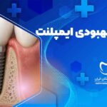 مراحل بهبودی ایمپلنت دندان