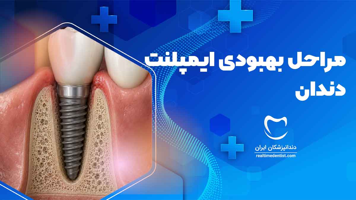 مراحل بهبودی ایمپلنت دندان
